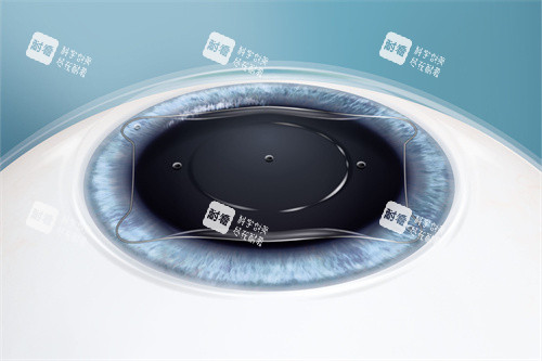 ICLV5晶体植入后的位置