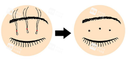皮下速接双眼皮操作过程图解 皮下速接双眼皮操作过程图解
