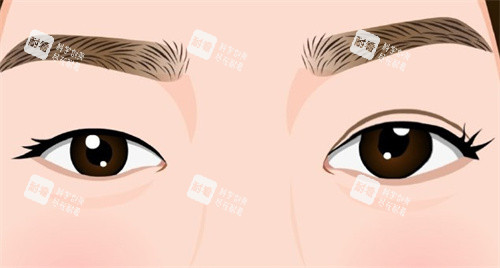 双眼皮手术术前术后对比卡通 双眼皮手术术前术后对比卡通