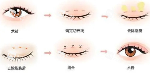 双眼皮手术过程图