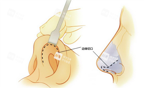 隆鼻手术的切口