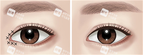 开眼角手术前后对比图 开眼角手术前后对比图