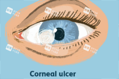角膜溃疡