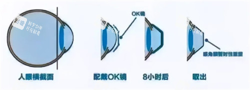 角膜塑形镜8小时后变化
