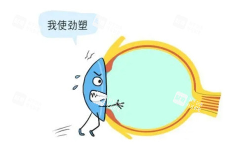 角膜塑形镜卡通概念图