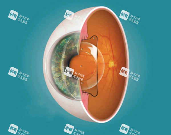 ICL手术细节分析图