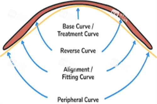 角膜塑形镜作用示意图