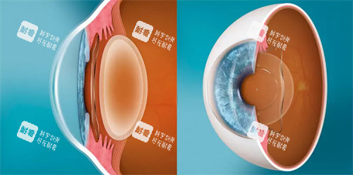 人工晶体植入正面和侧面对比