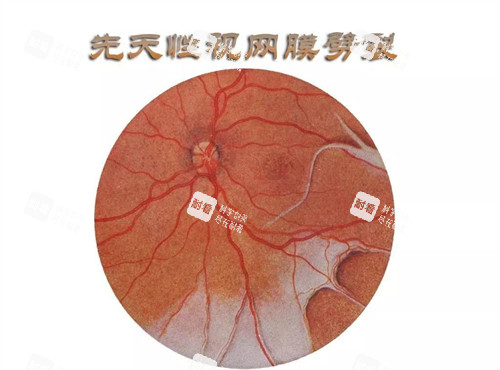 先天性视网膜劈裂图