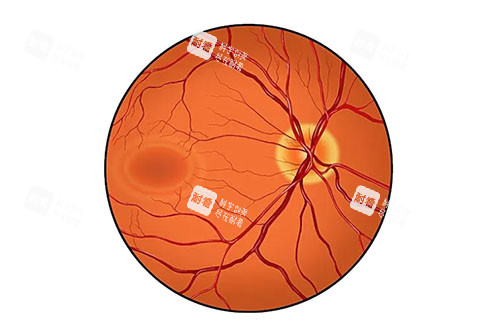 视网膜病变卡通图 