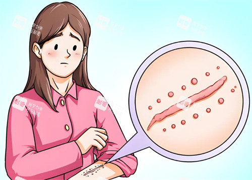 激光去疤能去掉手术疤痕吗 激光去疤能去掉手术疤痕吗