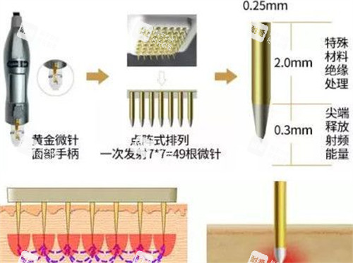 黄金微针手柄介绍 黄金微针手柄介绍