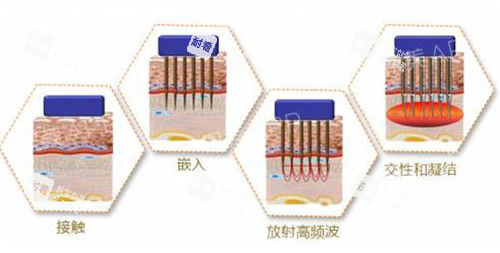 黄金微针原理解析 黄金微针原理解析