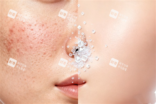 脸部祛痘卡通图 脸部祛痘卡通图