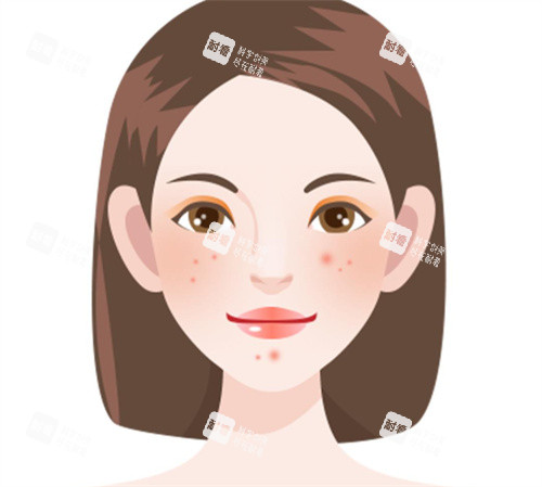 祛痘卡通展示图片 祛痘卡通展示图片