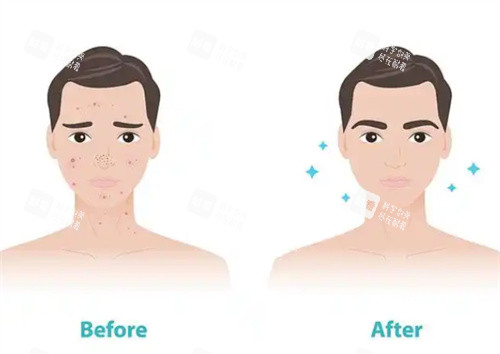 祛痘前后对比 祛痘前后对比