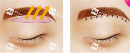 悬吊式提眉手术动画演示图
