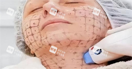 热玛吉中下面部设计点位图 热玛吉中下面部设计点位图