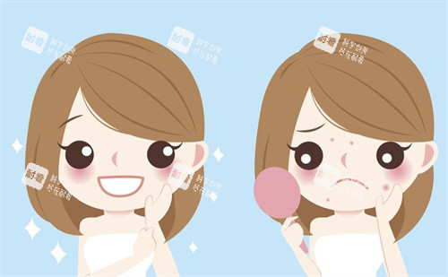 祛痘前后对比卡通图片