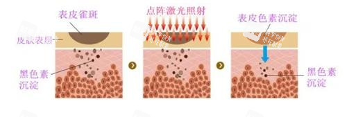 点阵激光的成效