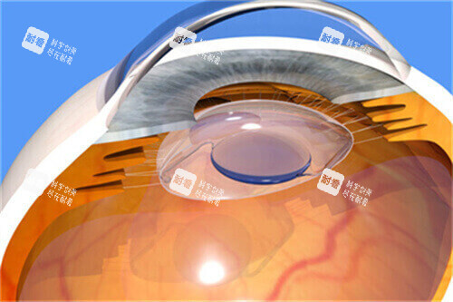 ICL晶体18 ICL晶体18