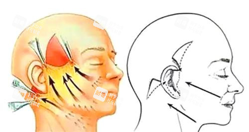 拉皮手术图 拉皮手术图