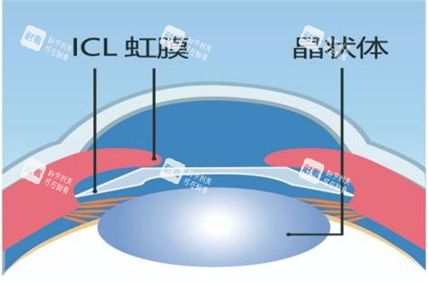 icl晶体植入手术图