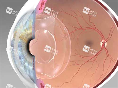 荷兰Oculentis人工晶体植入