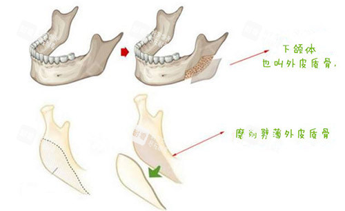 下颌角皮质骨截骨手术图片