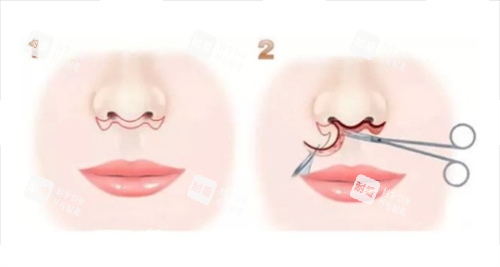 北京人中缩短选王晓健还是张曼好？深度对比两人隐痕技术、术例风格及口碑