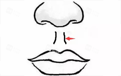 人中缩短术部位展示