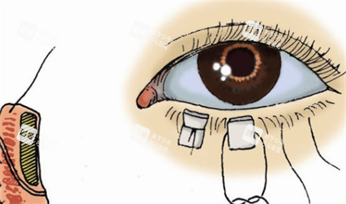 下眼睑外翻修复过程