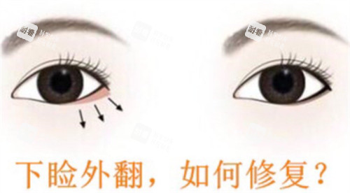 下眼睑外翻怎么办
