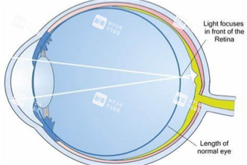 屈光不正近视示意图