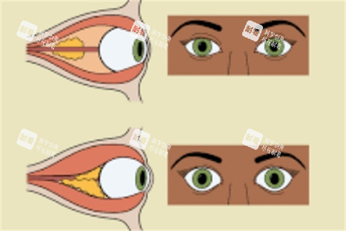 近视眼球对比图