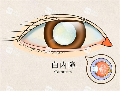 白内障手术图片