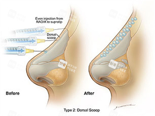 玻尿酸注射鼻背