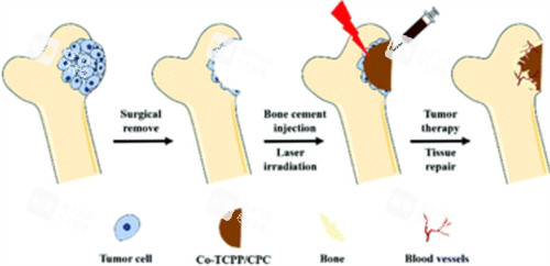 骨水泥修复缺损骨头 骨水泥修复缺损骨头
