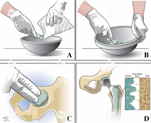 骨水泥修复过程 骨水泥修复过程