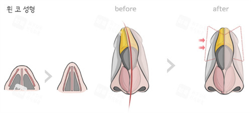 鼻整形前后对比 鼻整形前后对比