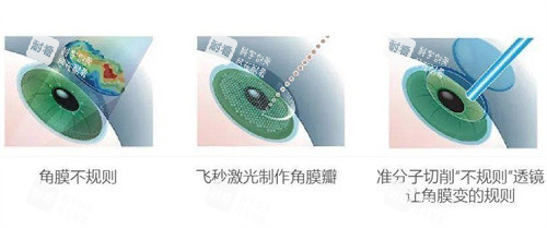 准分子激光 准分子激光