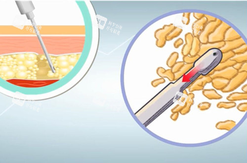 深度测评上海蔡跃波：吸脂技术稳且出脂量多，针对腰腹环吸1.5w起，术后平整不凹凸必看