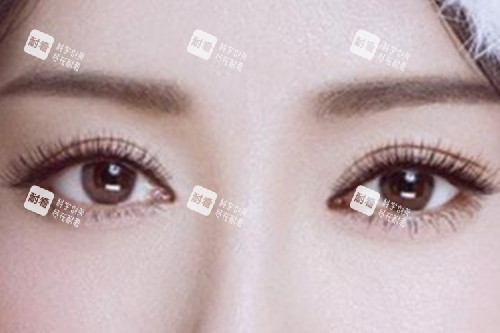 割双眼皮 割双眼皮