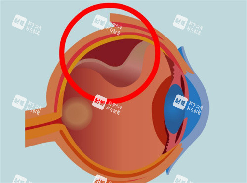 视网膜具体位置卡通图 视网膜具体位置卡通图