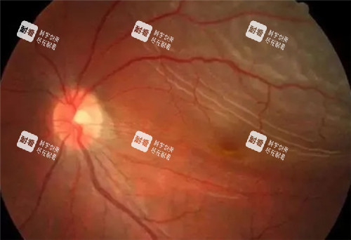视网膜脱落照片 视网膜脱落照片