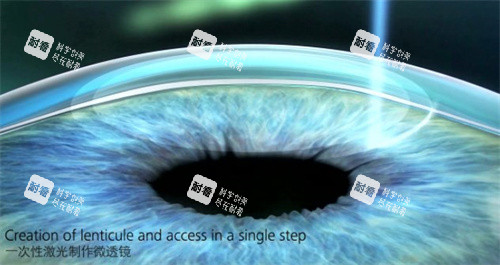 激光手术示意图 激光手术示意图