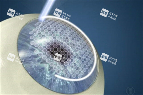 半飞秒激光手术过程 半飞秒激光手术过程