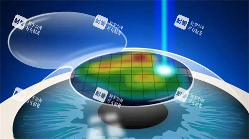 个性化微飞秒手术过程图片 个性化微飞秒手术过程图片