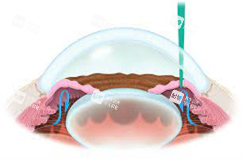 虹膜切除术 青光眼 虹膜切除术 青光眼