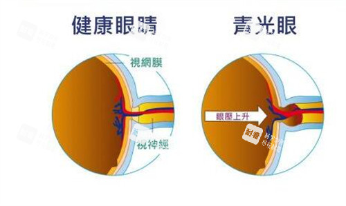 正产眼对比青光眼展示图 正产眼对比青光眼展示图
